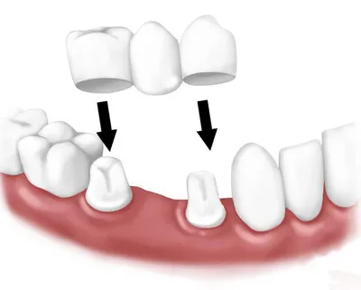 ≡ Стоматологический зубной мост 【Sanelen DENT 】