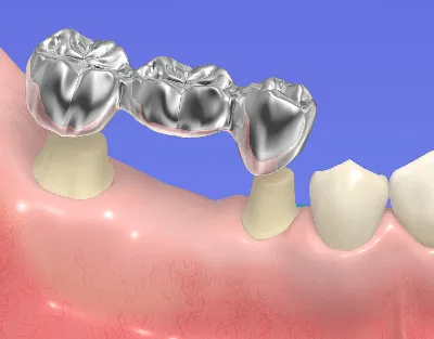 Мостовидные протезы в Минске │ Цена зубного моста