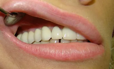 Зубной мост [виды и цена на 2, 3, 4 зуба, как ставят]