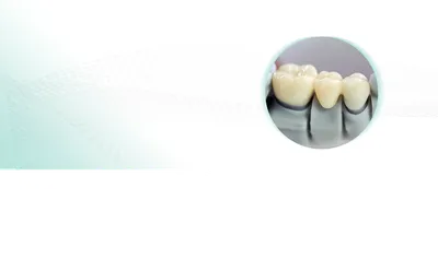 Зубной мост [поставить на 2, 3, 4 зуба цена, фото до и после]