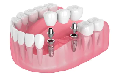 Мостовидный протез: изготовление и установка в Харькове