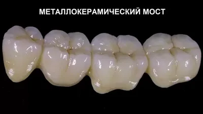 Мост на зубы: как ставят и когда требуется мостовидный протез? | Журнал  Startsmile о стоматологии | Дзен