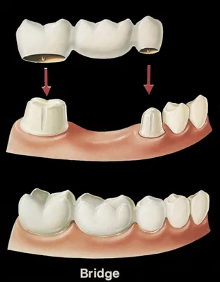 Мостовидный протез в Твери: цена на зубной мост | Дента-Люкс