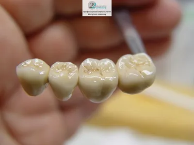 Коронки и зубные мосты - фото до и после установки