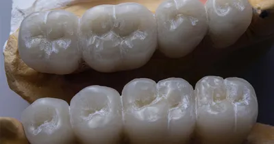 Коронки на зубы – как выбрать | Vidnova