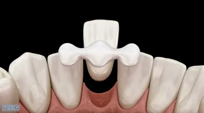 5 фактов о вреде мостовидных протезов на свои зубы | Стоматология  Smile-at-Once | Дзен