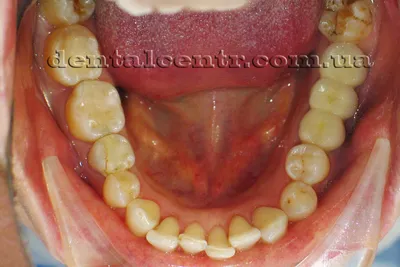 Керамические зубные мосты в стоматологии \"22 Век\", отзывы и цены