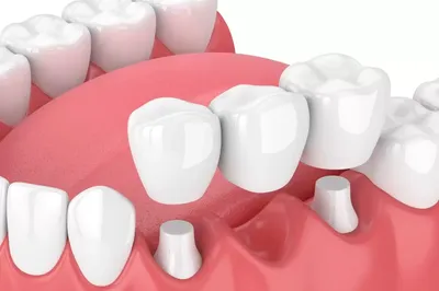 Dental Angels Стоматология Бишкек - Бруклинский мост? \"Что это?\" - спросите  вы в стоматологии. ⛩ Да, вы не ослышались, мы не только лечим зубы, но и  строим мосты... Если между Вашими зубами