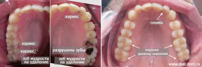 Металлокерамический мост на 10 зубов пришел в негодность – ортопед Сергей  Самсаков, Москва