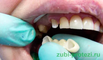 Мост на зубы: как ставят и когда требуется мостовидный протез? | Журнал  Startsmile о стоматологии | Дзен
