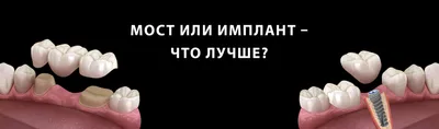 Мост (зубной мост) или мостовидная конструкция