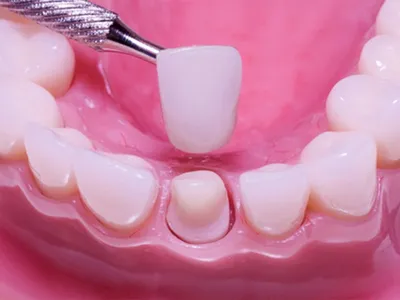 Какой протез лучше: зубной мост на коронки или на имплантат?