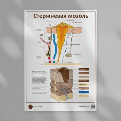 Ногтевая Студия Ева - Стержневая мозоль 👀 ⠀ Сначала ❤️мне будет приятно❤️  ⠀ Стержневая мозоль имеет стержень (корень), иногда ее называют корневой,  корень располагается глубоко в коже и может даже проникать в