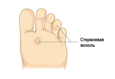 Мозоль – что это такое, 💉 лечение, симптомы и 🔬 диагностика на МЕД Zoon