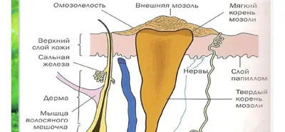 Как избавиться от стержневой мозоли домашними средствами. 17 марта 2023 г.  Кубанские новости