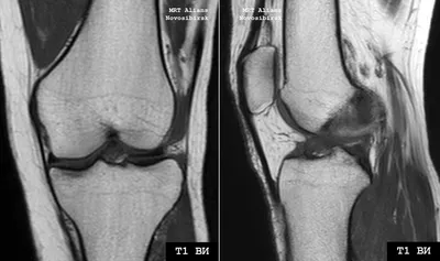 Мрт колена фото