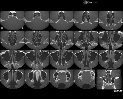 Расшифровка КТ пазух носа | Второе мнение