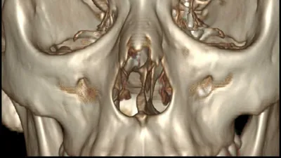 КТ пазух носа в Новогиреево и Перово, сделать КТ придаточных пазух носа