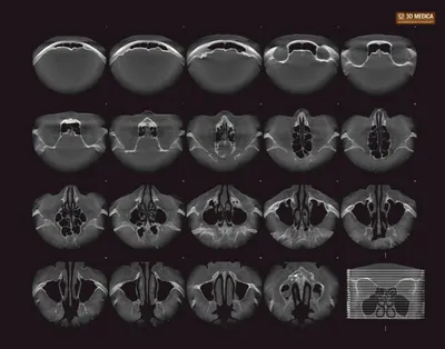 МРТ придаточных пазух носа - Магнитно-резонансная томография в  Санкт-Петербурге | Приоритет диагностика