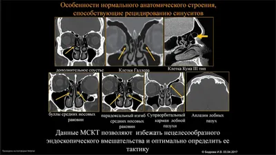 Диагностика гайморовых пазух носа при помощи КЛКТ (Конусно-лучевая  компьютерная томография в 3D проекции) » ЛОР клиника «ЛОР-Практика» в  Алматы: лечение заболеваний уха, горла, носа у детей и взрослых