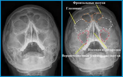 Компьютерная томогорафия придаточных пазух носа - фото - ЛОР в Самаре -  врач Лунёв Андрей Владимирович