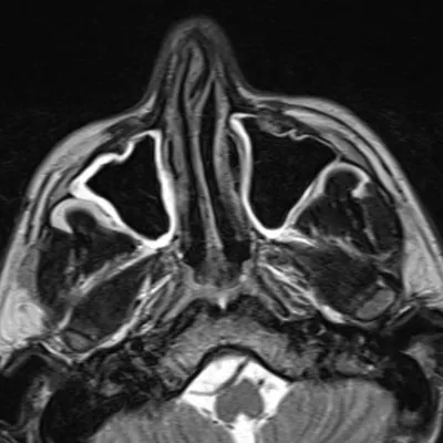 Простыми словами! Все о МРТ пазух носа с контрастом и без