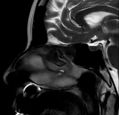 МРТ (магнитно-резонансная томография) придаточных пазух носа в Нижнем  Новгороде | ТОНУС ЛАЙФ