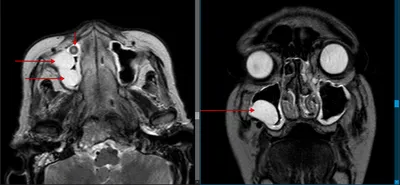 Киста верхнечелюстной пазухи - фото - ЛОР в Самаре - врач Лунёв Андрей  Владимирович