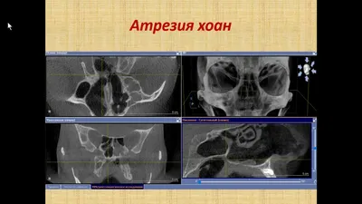 МРТ околоносовых пазух всего от 2 500 рублей