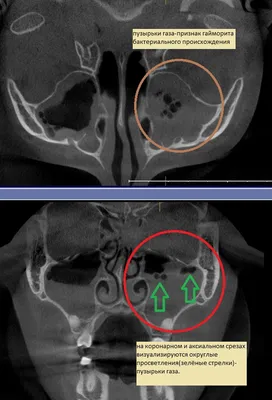 Снимок гайморовых пазух – что лучше: КТ или рентген? - Центр лучевой  диагностики Дмитрия Рогацкина