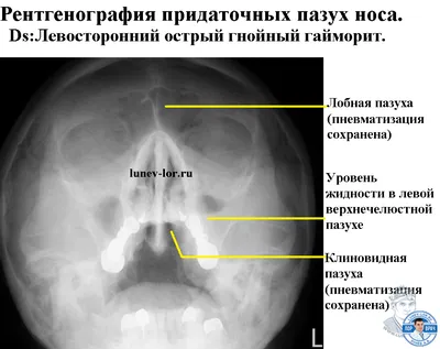 Диагностика пазух носа: околоносовых, придаточных, гайморовых в СПб