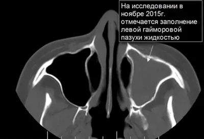 Что показывает КТ пазух носа? Как делают, КТ или МРТ что лучше?