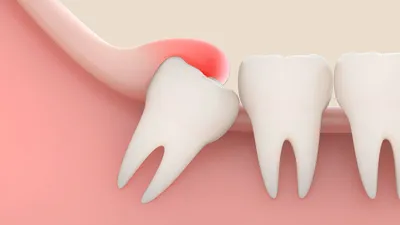 Зубная боль: как избавиться от «незваного гостя» | Healthy Dent (Киев)