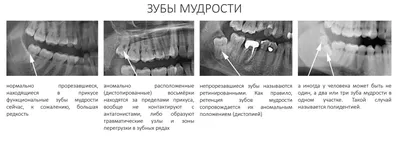 Последствия несвоевременного удаления зубов мудрости. Часть I / Хабр