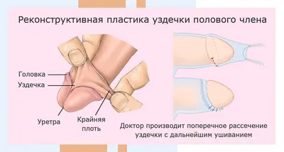 Пластика (френулопластика) уздечки полового члена: как проходит, цена в  Москве в клинике АльтраВита