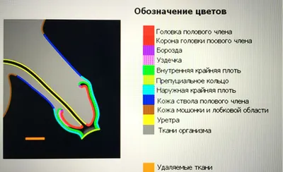 Короткая уздечка крайней плоти - цена пластики уздечки члена в Украине |  Клиника Биляка