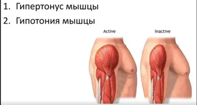 Мышечная дистония. В чем опасность? | Детский бассейн \"Морские звезды\" |  Дзен