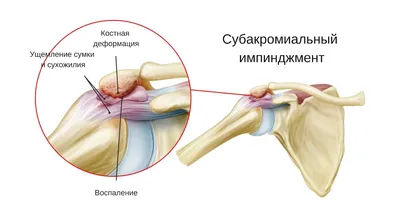 Синдром защемления грушевидной мышцы седалищного нерва у женщин: симптомы,  лечение, причины