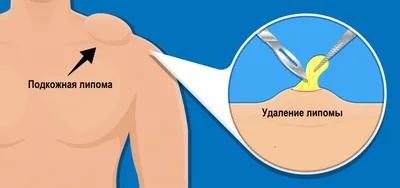 Blog | Замена тазобедренного сустава (эндопротезирование тазобедренного  сустава)