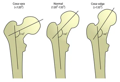 Coxa Valga: причины, симптомы, диагностика, лечение ᐉ блог Ladisten