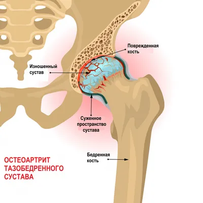 Лечение Повреждение суставной губы - Ортопедия Руслана Сергиенко