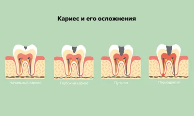 Нерв В Зубе Как Удаляют Как Выглядит ЛюмиДент