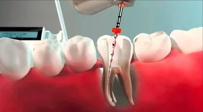 Удаление нерва зуба мышьяком - Сколько убивают нерв?
