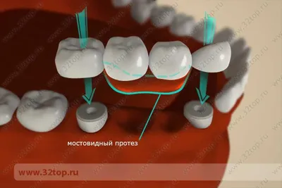 Пломбирование зуба - Стоматология - Форум стоматологов (стомотологический  форум) - Профессиональный стоматологический портал (сайт) «Клуб  стоматологов»