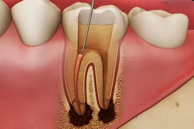 Удаление нерва зуба: цена в Москве на депульпирование и чистку каналов,  отзывы, этапы лечения в клинике стоматологии