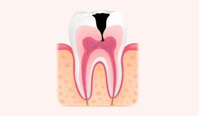 Лечение пульпита по недорогой цене в Екатеринбурге. Лечение пульпита зуба  по доступной стоимости в стоматологии, лечить пульпит в клинике Приоритет