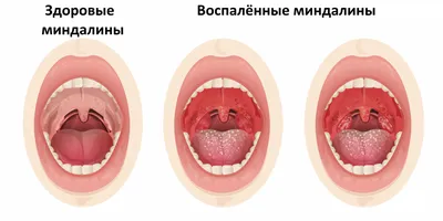 Почему появляются белые пятна во рту? 6 возможных причин | Стоматология  ROOTT | Дзен