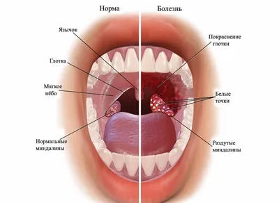 Тонзиллит острый и хронический: лечение тонзиллита у взрослого и ребенка