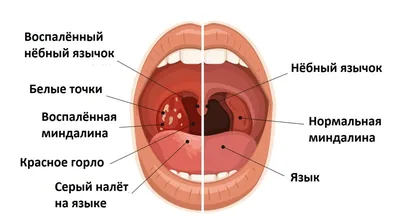 Тонзиллит - причины появления, симптомы заболевания, диагностика и способы  лечения