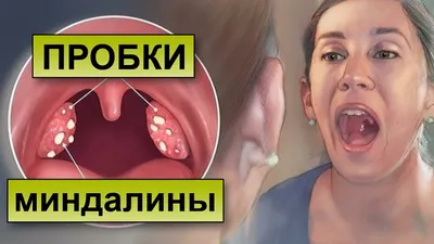 КАК УХОДЯТ ПРОБКИ ИЗ МИНДАЛИН - YouTube